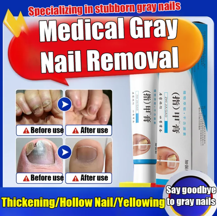 Fungal Nail Treatment Cream
